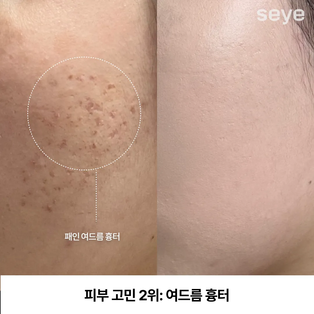 피부 고민 여드름 흉터.webp