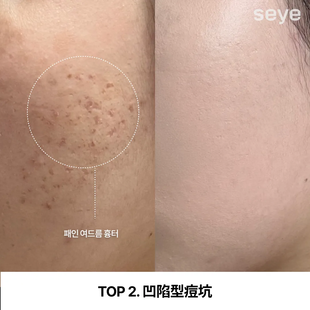피부-고민-여드름-흉터.webp