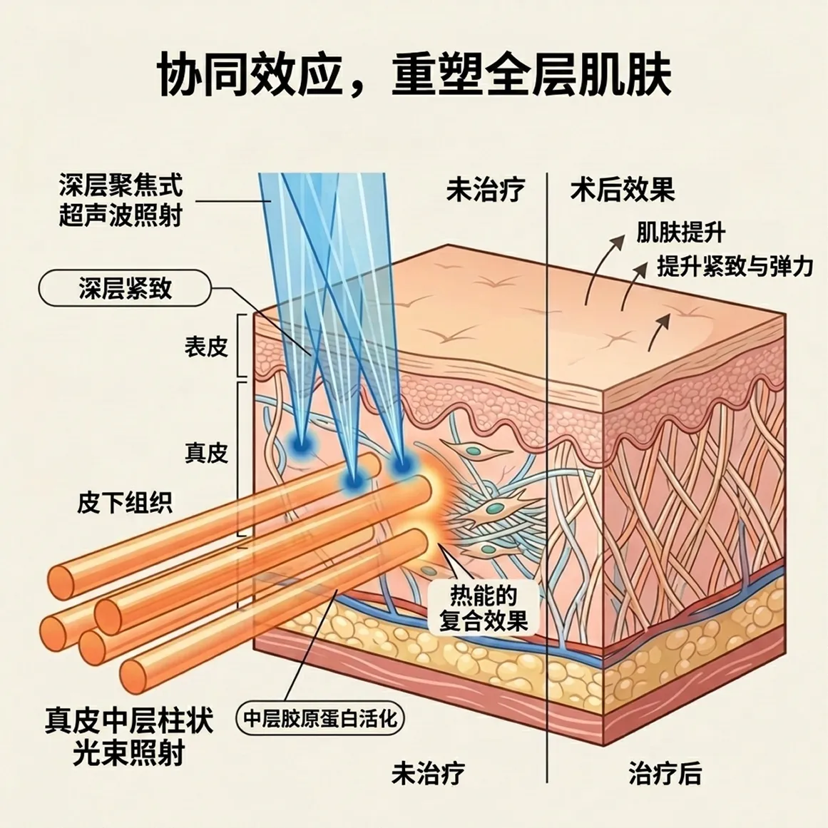 2协同效应，重塑全层肌肤-提升紧致与弹力-深层聚焦式-超声波照射-zh-cn.webp