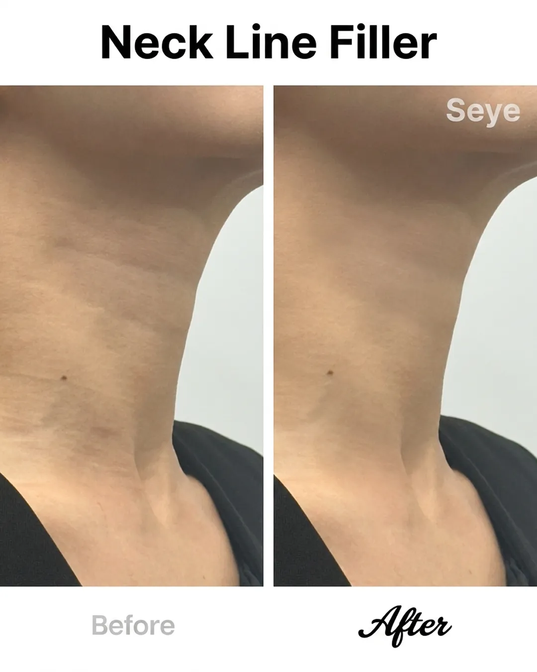 2-neck-line-filler-before-after-seye-en.webp