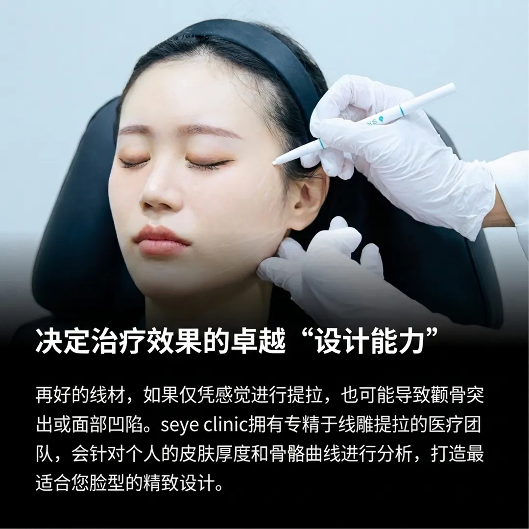 3공식-압토스-4-。seye-clinic，再好的线材，如果仅凭感觉进行提拉，也可能导致颧骨突出或面部凹陷。seye-zh-cn.webp