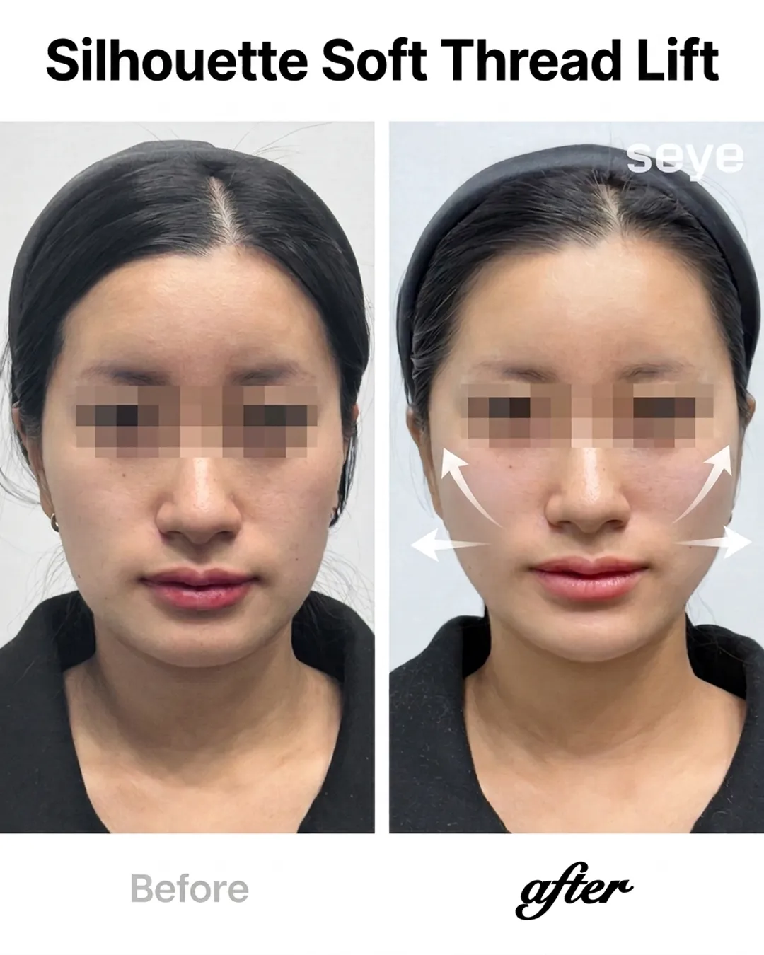 30-silhouette-soft-thread-before-after-seye-en.webp