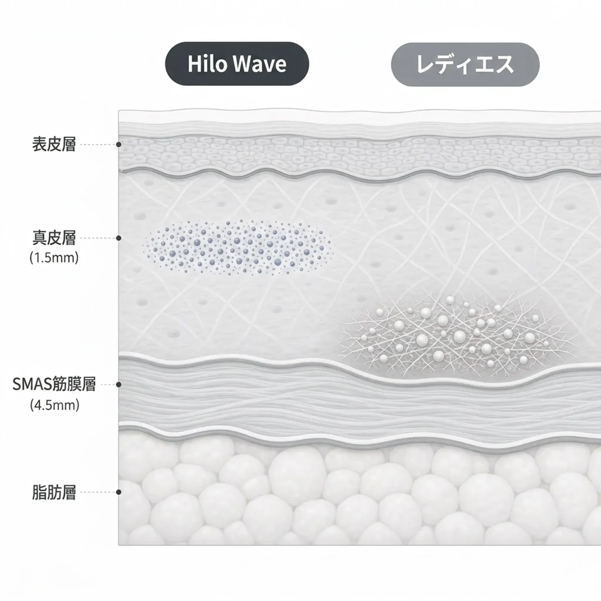 484-Hilo-Wave-1-5mm-4-SMAS筋膜層-ja.webp