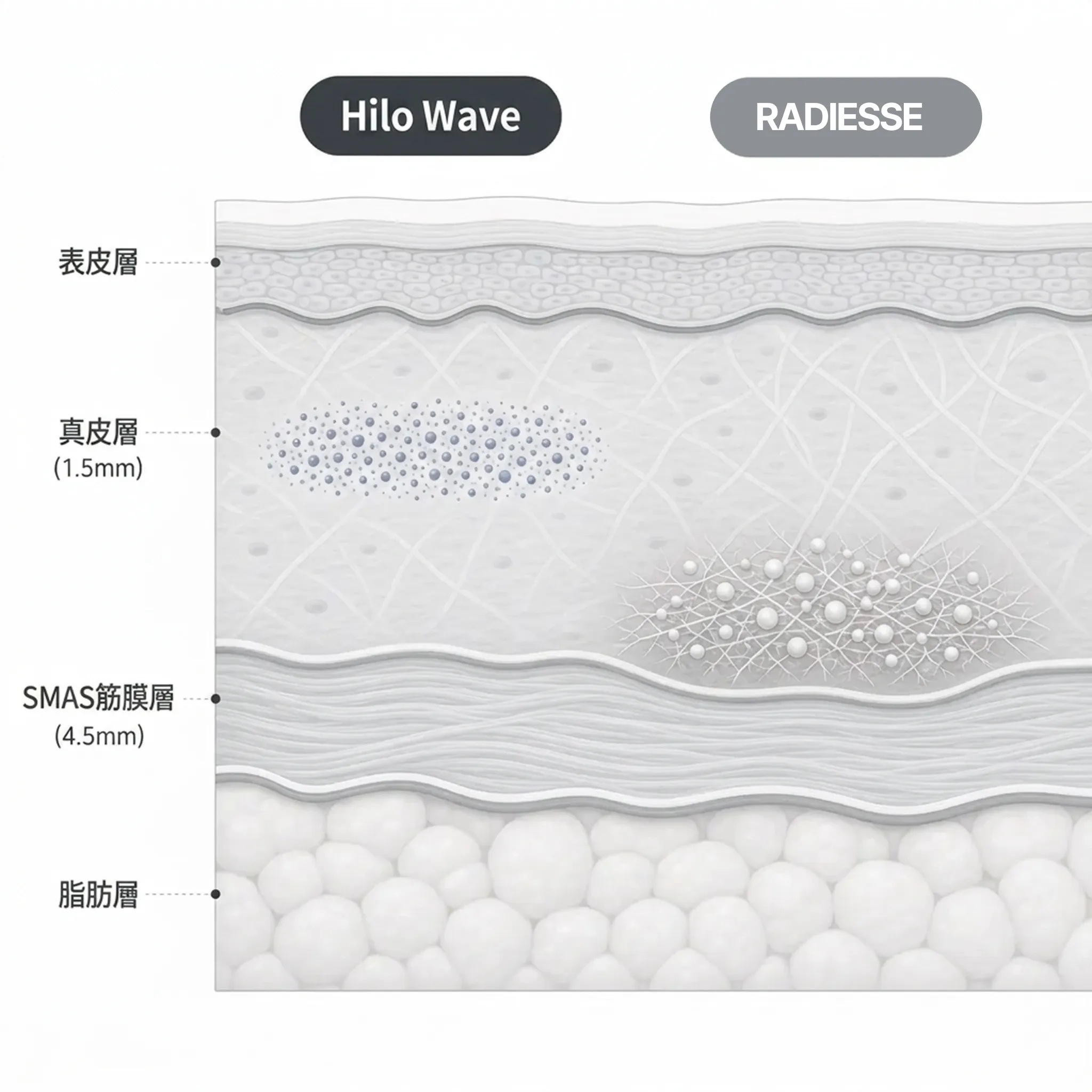 484-Hilo-Wave-1-5mm-4-SMAS筋膜層-tw.webp
