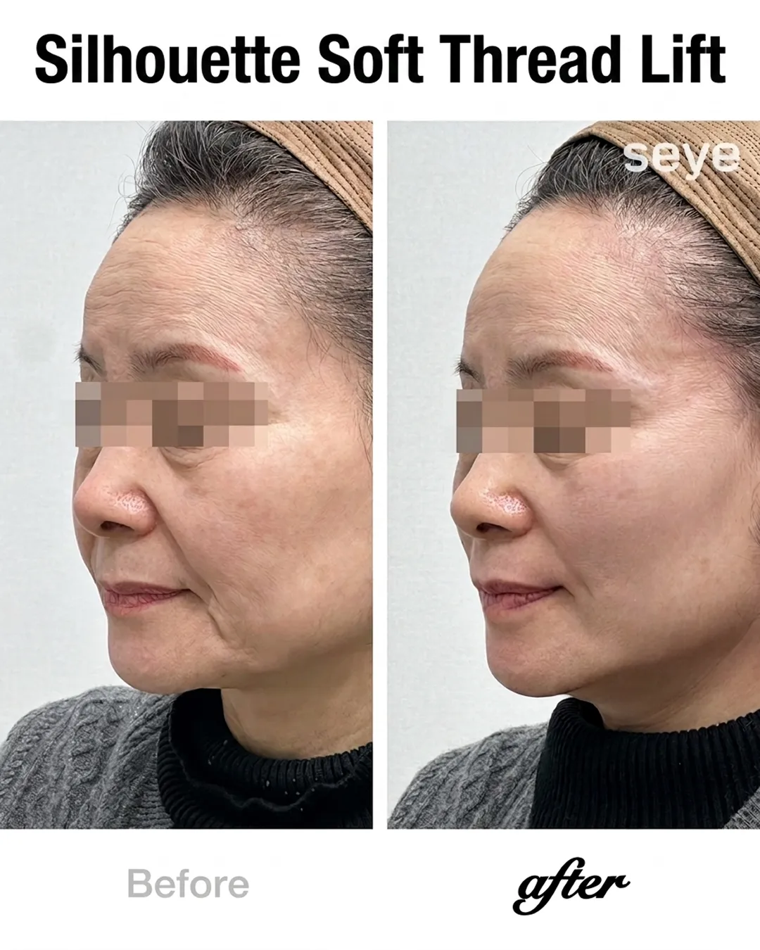 50-silhouette-soft-before-after-seye-en.webp