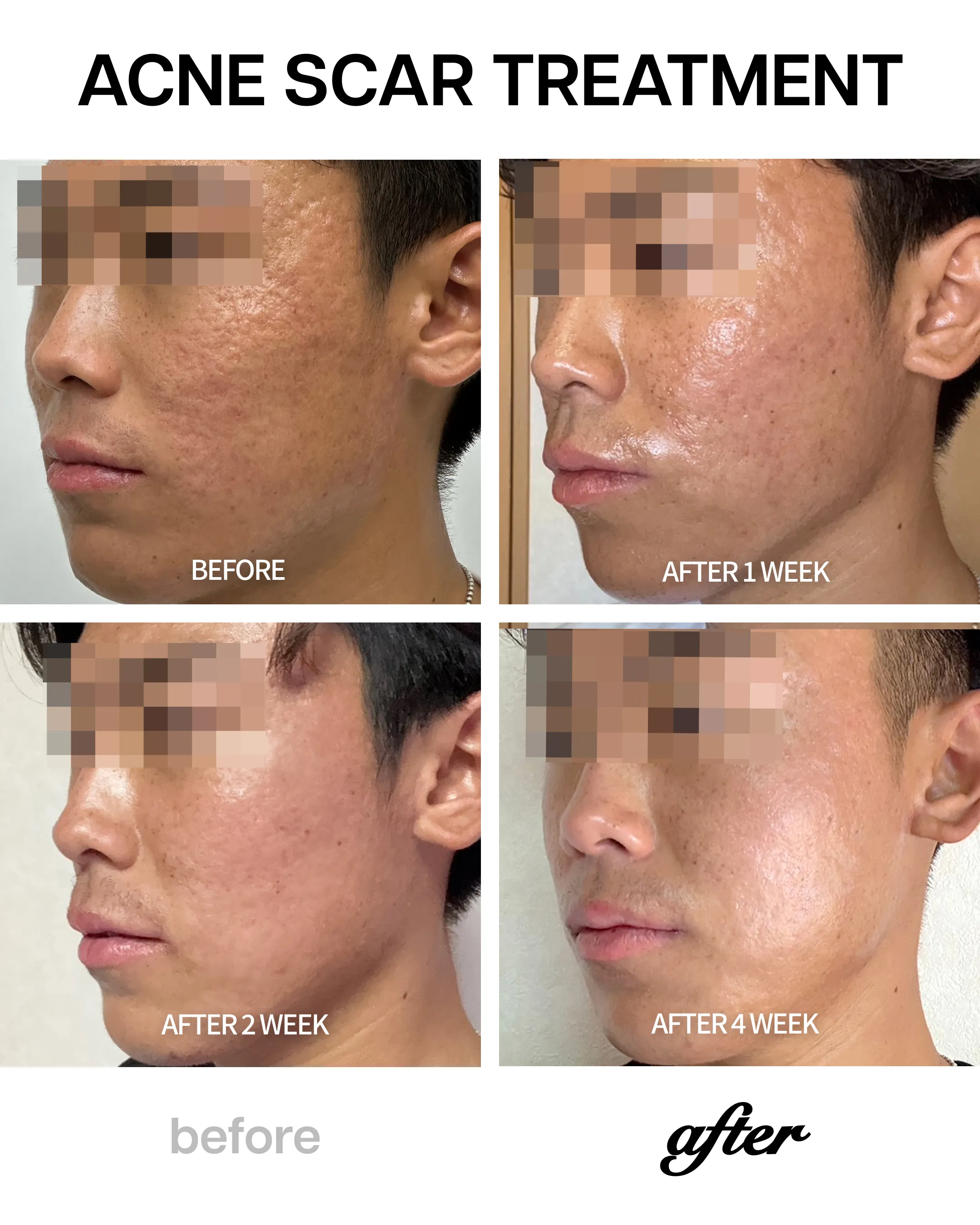 Acne-Scar-Treatment-クレーター肌改善の症例レビュー|キュアジェットとスキンブースターを組み合わせたニキビ跡複合アプローチ.webp