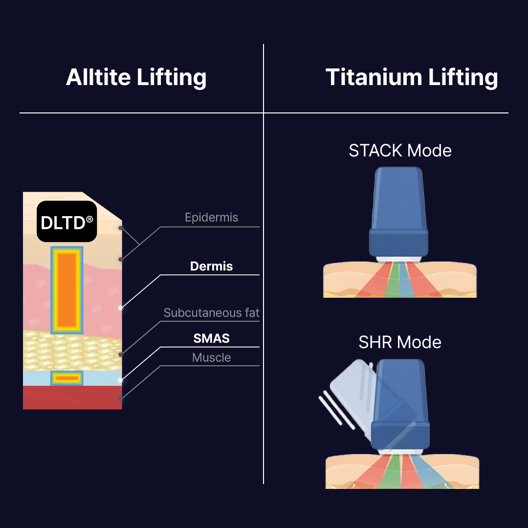 Before and after comparison of Alltite and Titanium lifting results on the jawline and face