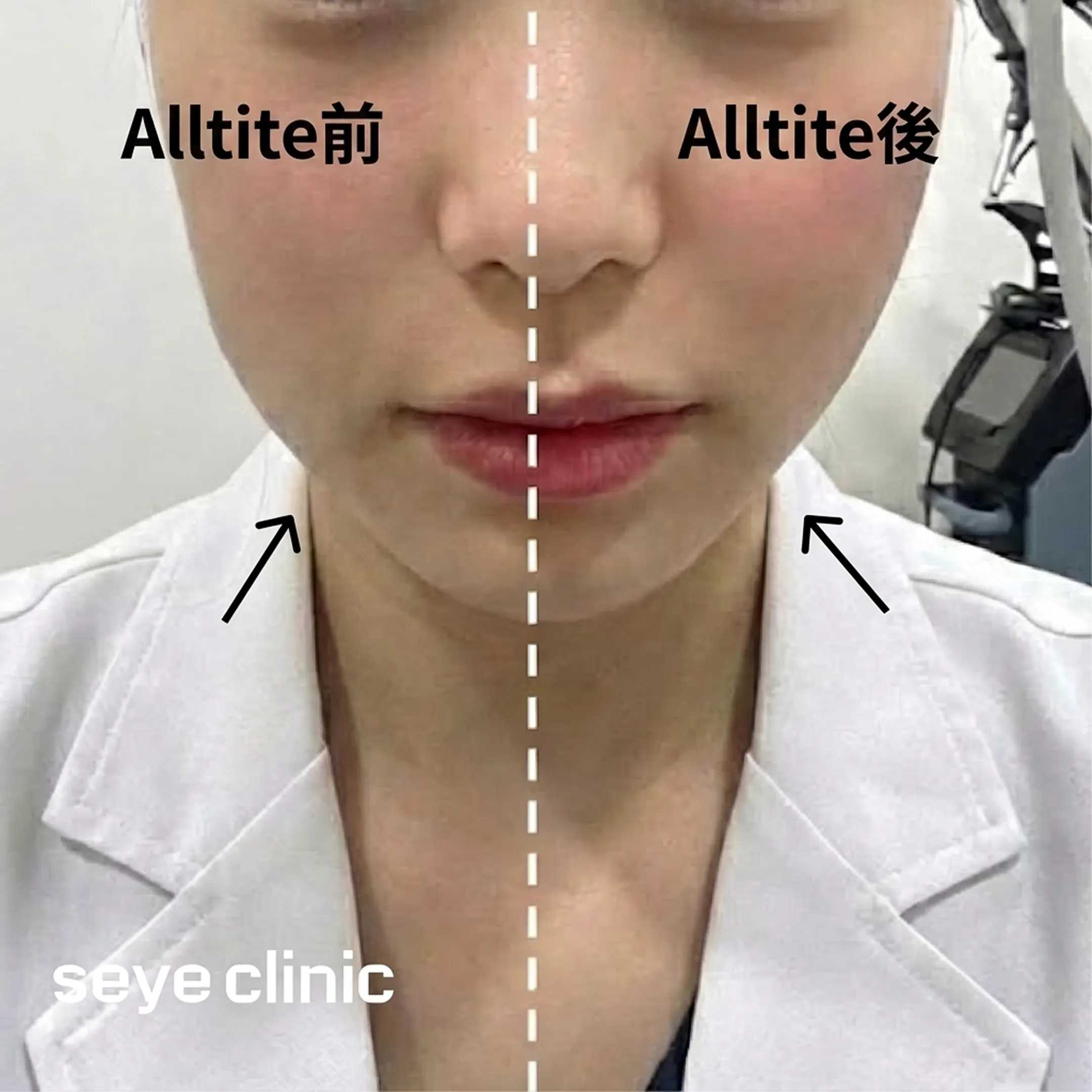 Alltite拉提專業診所推薦評價-seye-clinic-Alltite前-Alltite後-zh-tw.webp