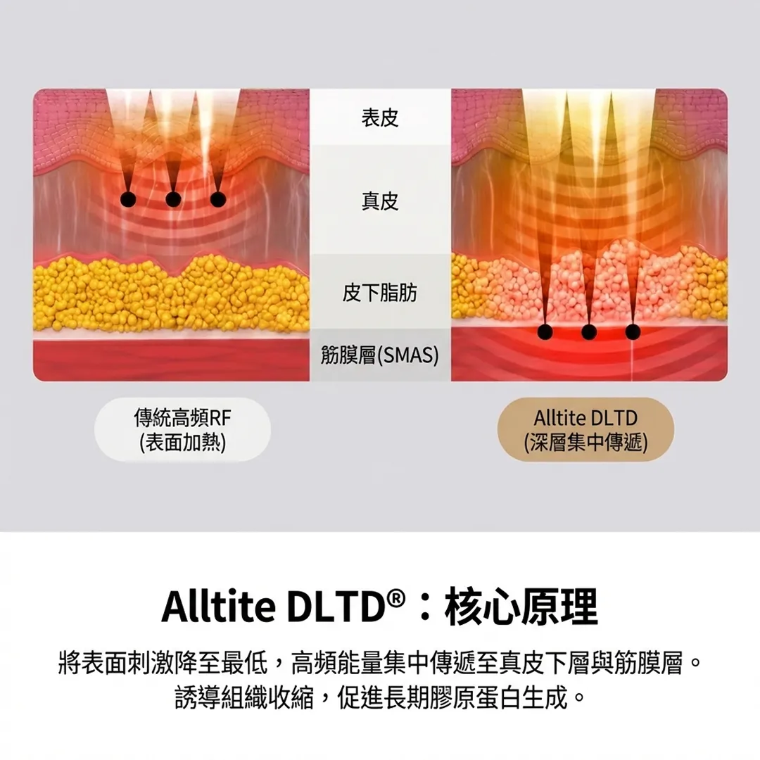 Alltite緊緻拉提的原理和作用.webp