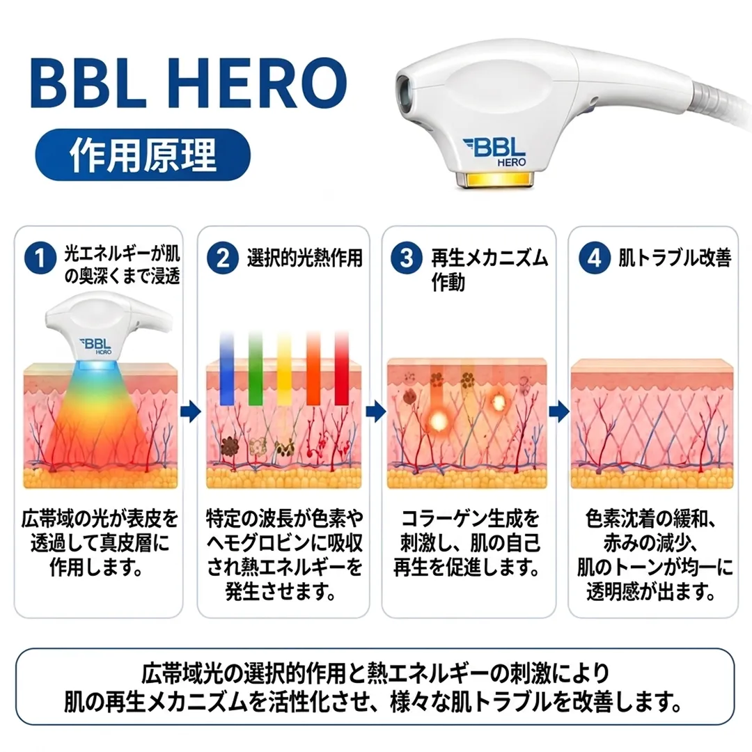 BBL-HERO-光エネルギーが肌の-奥深くまで浸透-選択的光熱-ja.webp