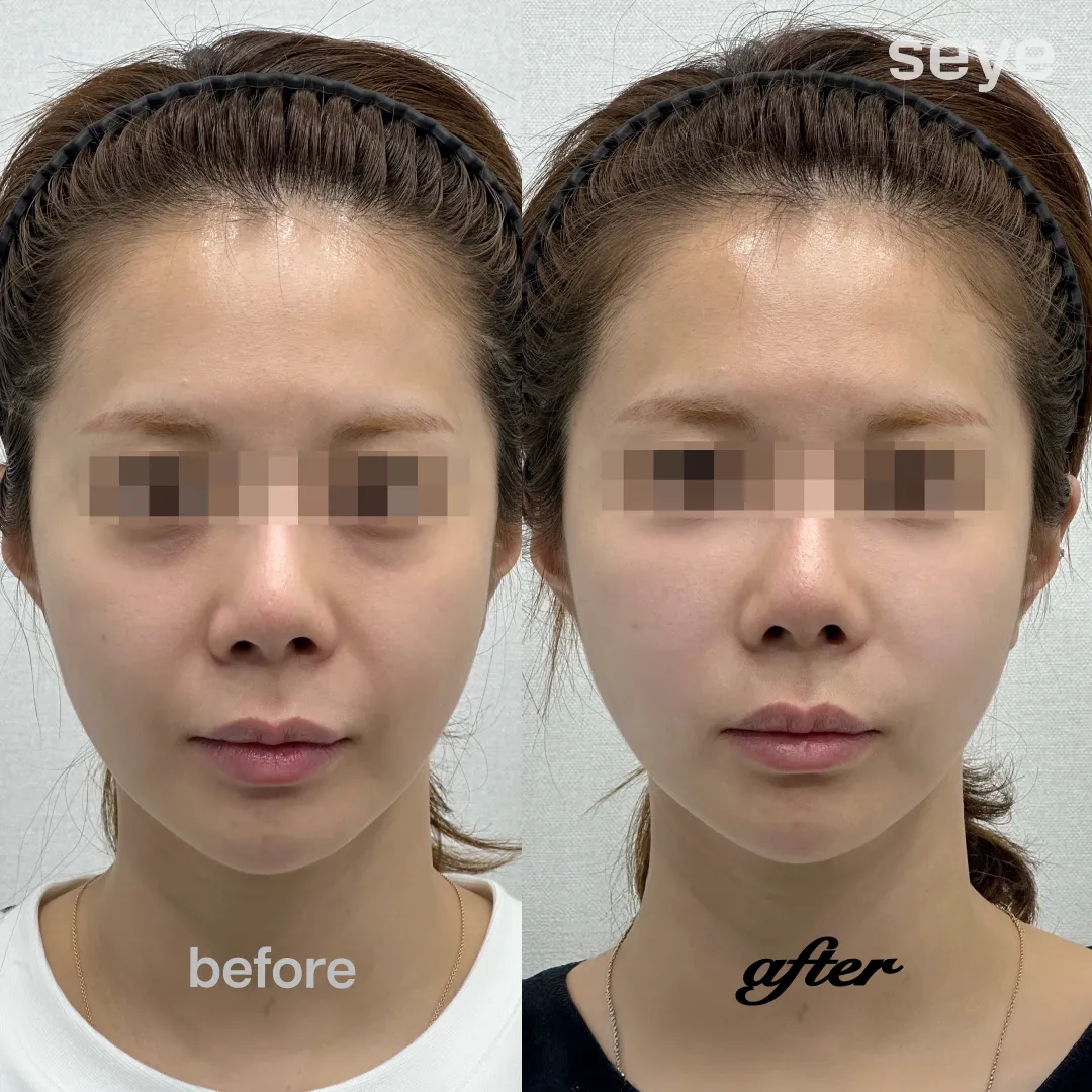 HILO WAVEのビフォーアフター.webp