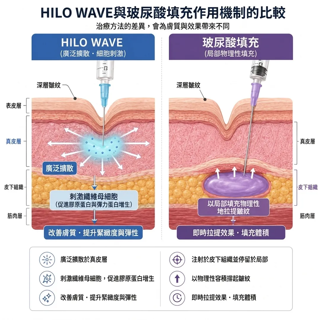 HILO-WAVEとフィラーの作用メカニズム比較-WAVE與玻尿酸填充作用機制的比較-治療方法的差異,會為膚質與效果帶來不同-WAVE-局部物理性填充-zh-tw.webp