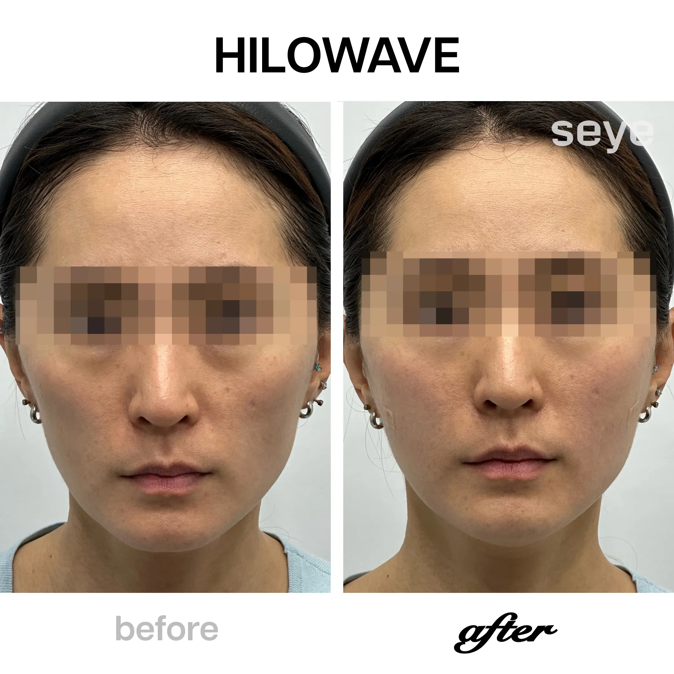 Hilowave胶原水光治疗前后对比效果korea-seoul-gangnam-hilowave-before-after-result.webp