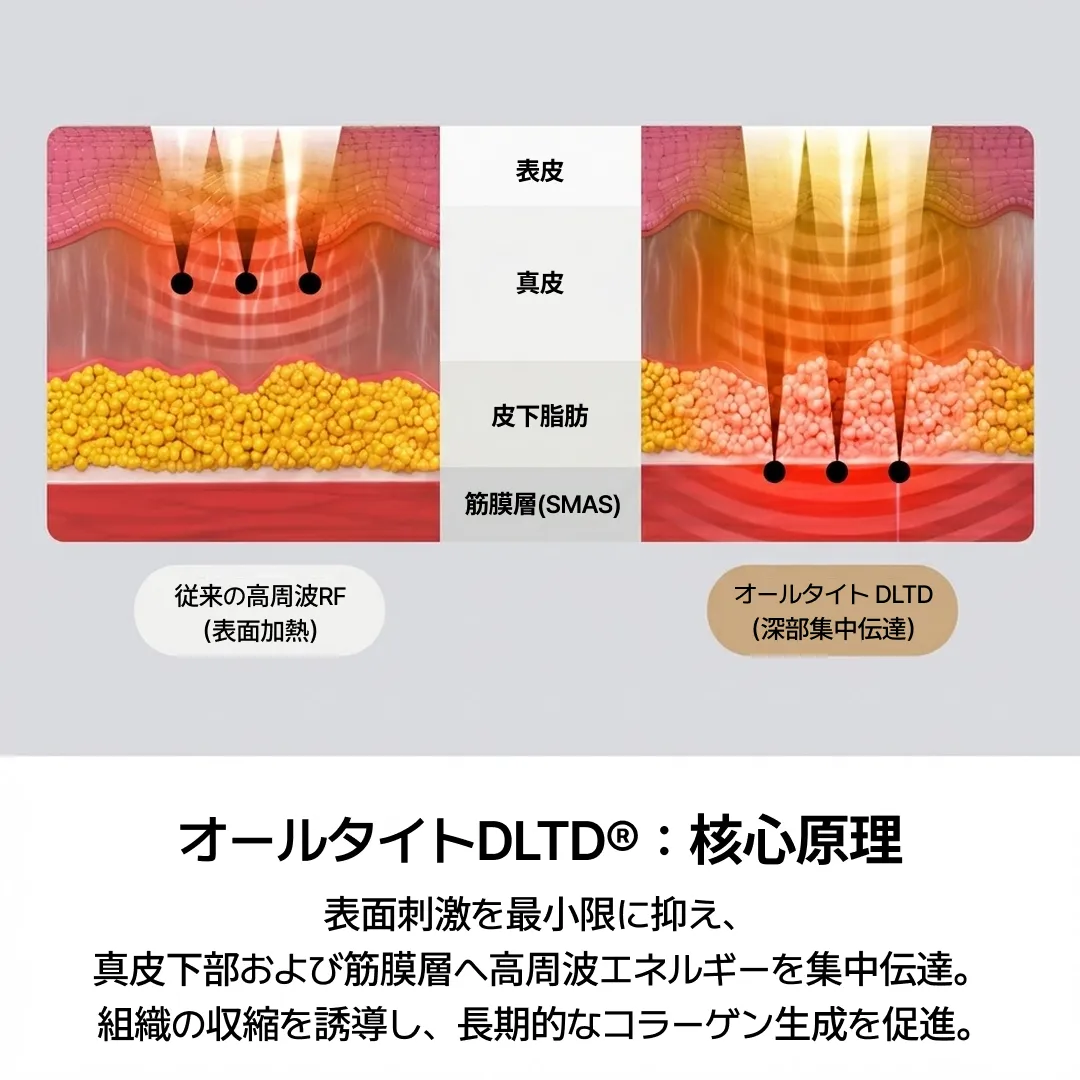 JP_올타이트 리프팅 원리 DLTD-1.webp