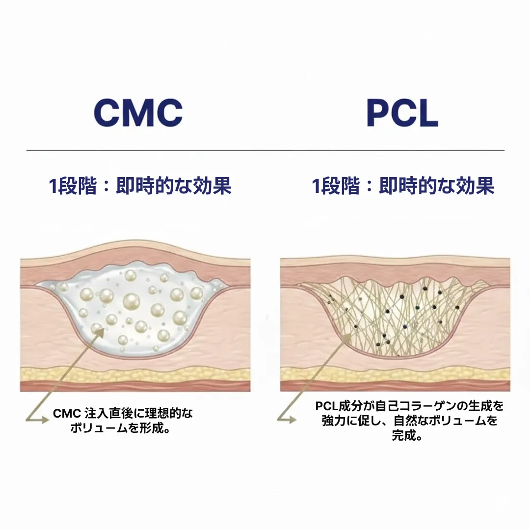 JP_엘란쎄 필러 효과.webp