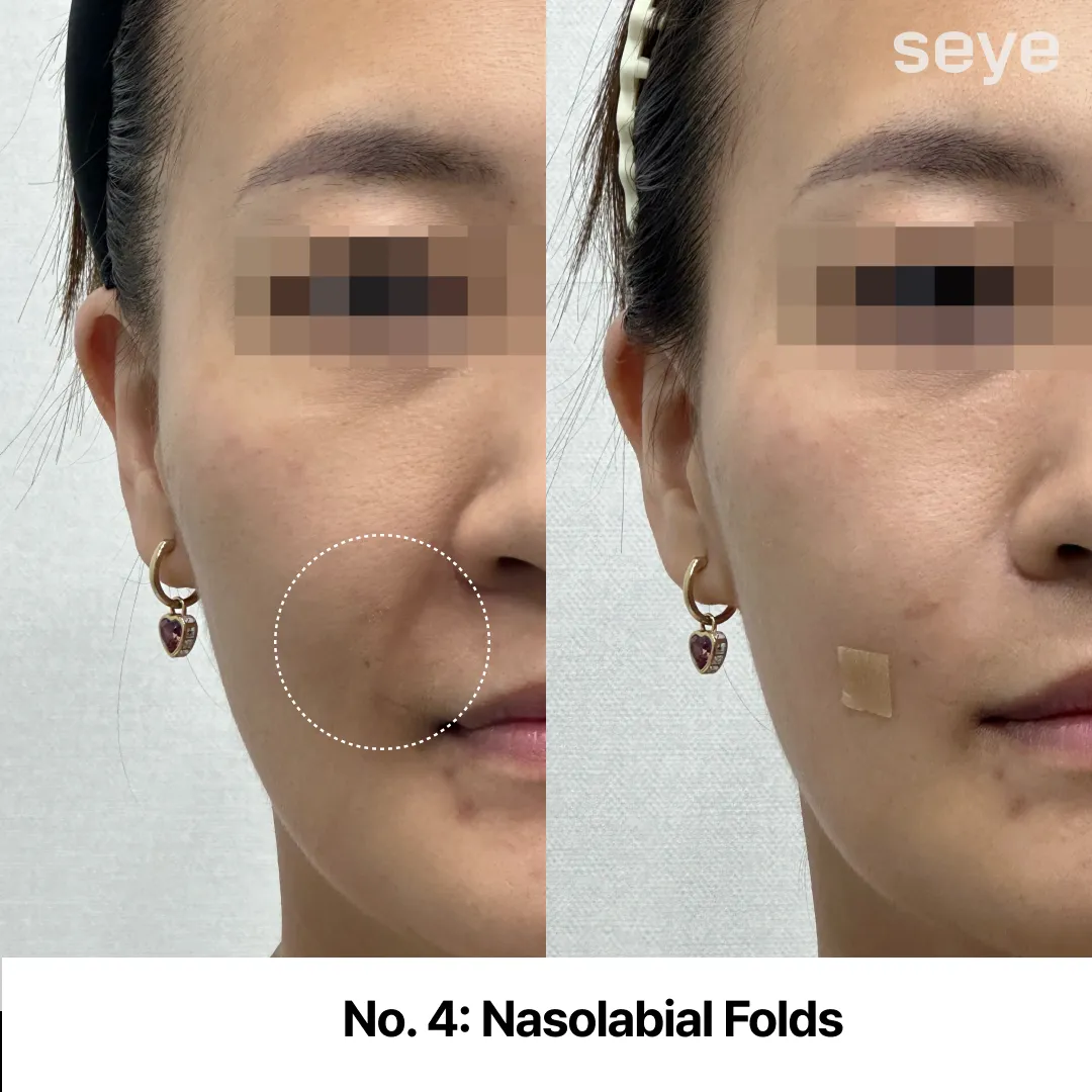 Nasolabial Folds (Structural Sagging).webp