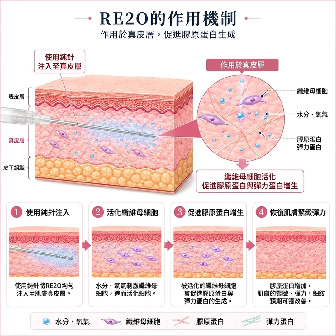 RE2O-リトゥオ-の肌再生メカニズム-1-作用於真皮層，促進膠原蛋白生成-RE2O的作用機制-注入至真皮層-作用於真皮層-zh-tw.webp