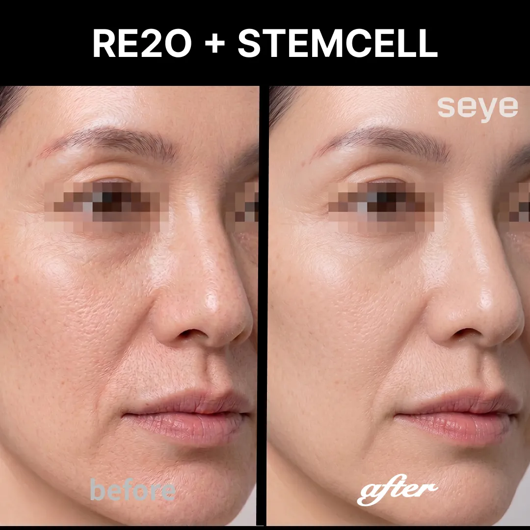 Re2o+stemcell before and after.webp