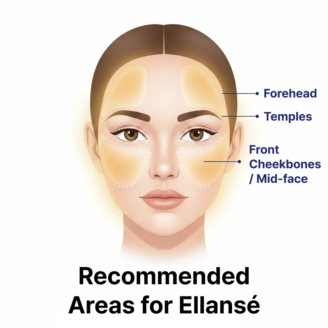 Recommended Areas for Ellansé.webp