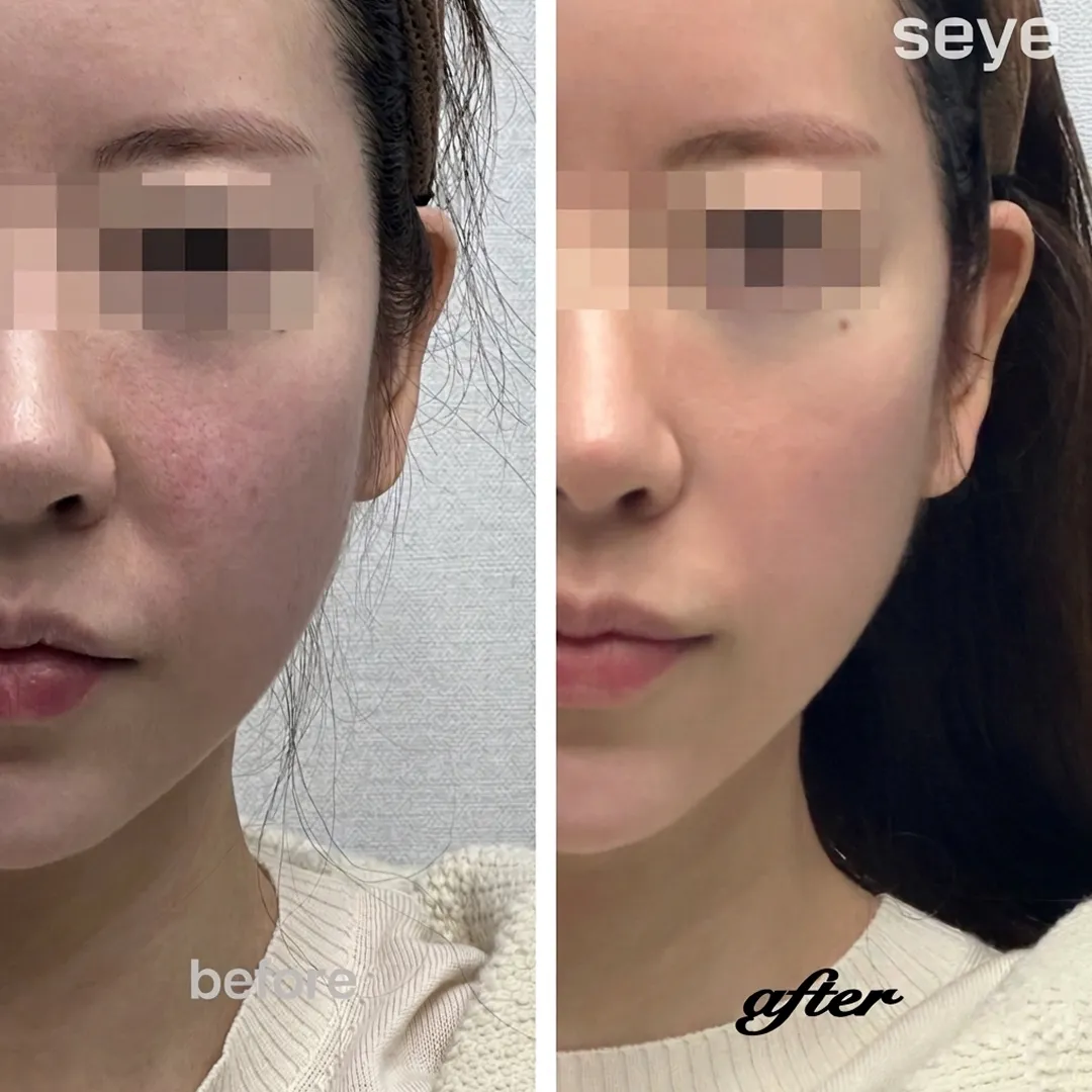 BBL laser before and after treatment for facial redness and pigmentation at Seye Clinic Seoul
