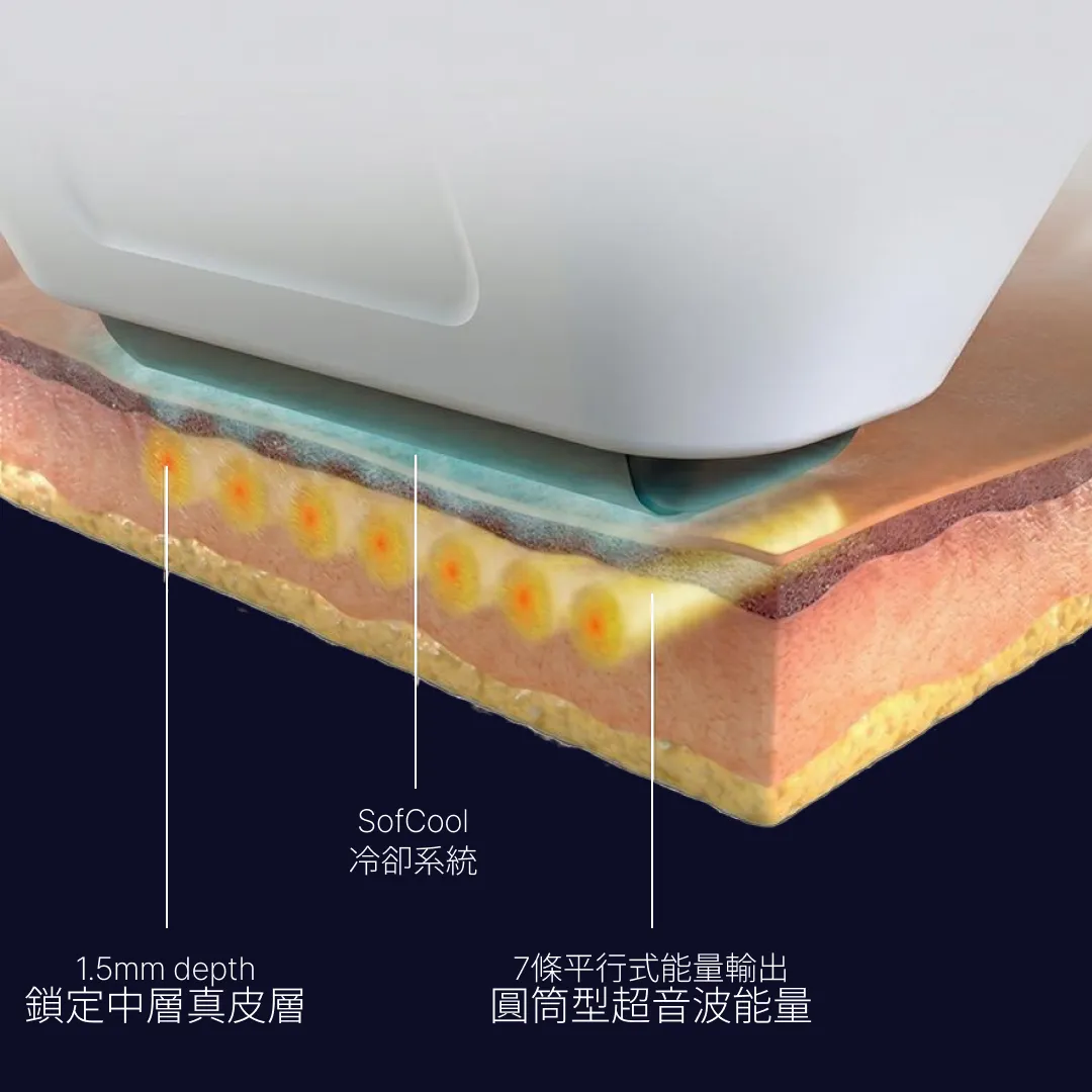 Sofwave-原理.webp