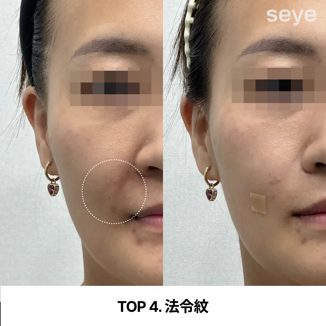 TOP 4. 法令紋.webp