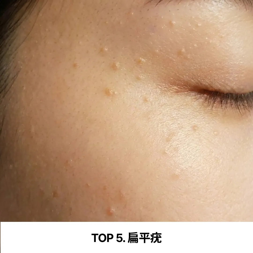 TOP 5. 扁平疣.webp