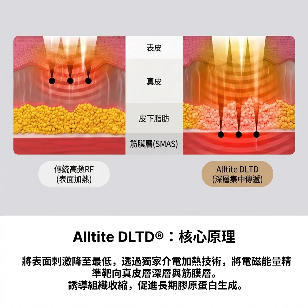 alltite原理-DLTD-Alltite-深層集中傳遞-表面刺激降到最低,將高頻能量集中至真皮下層-與筋膜層-SMAS-zh-圖文.webp
