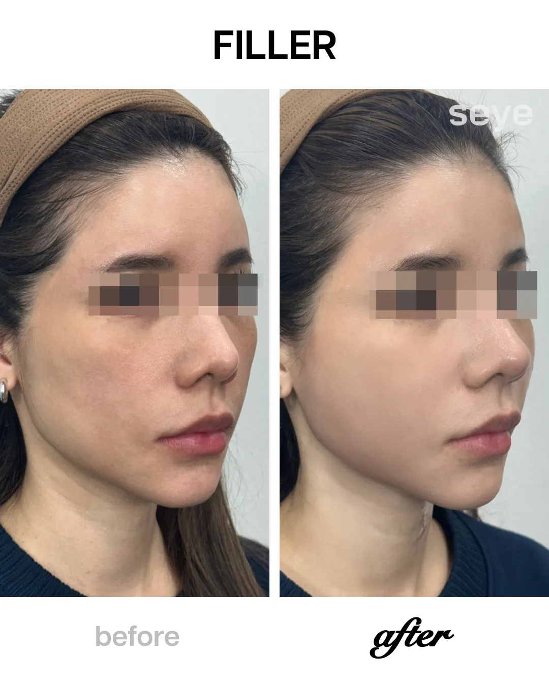 Filler before and after