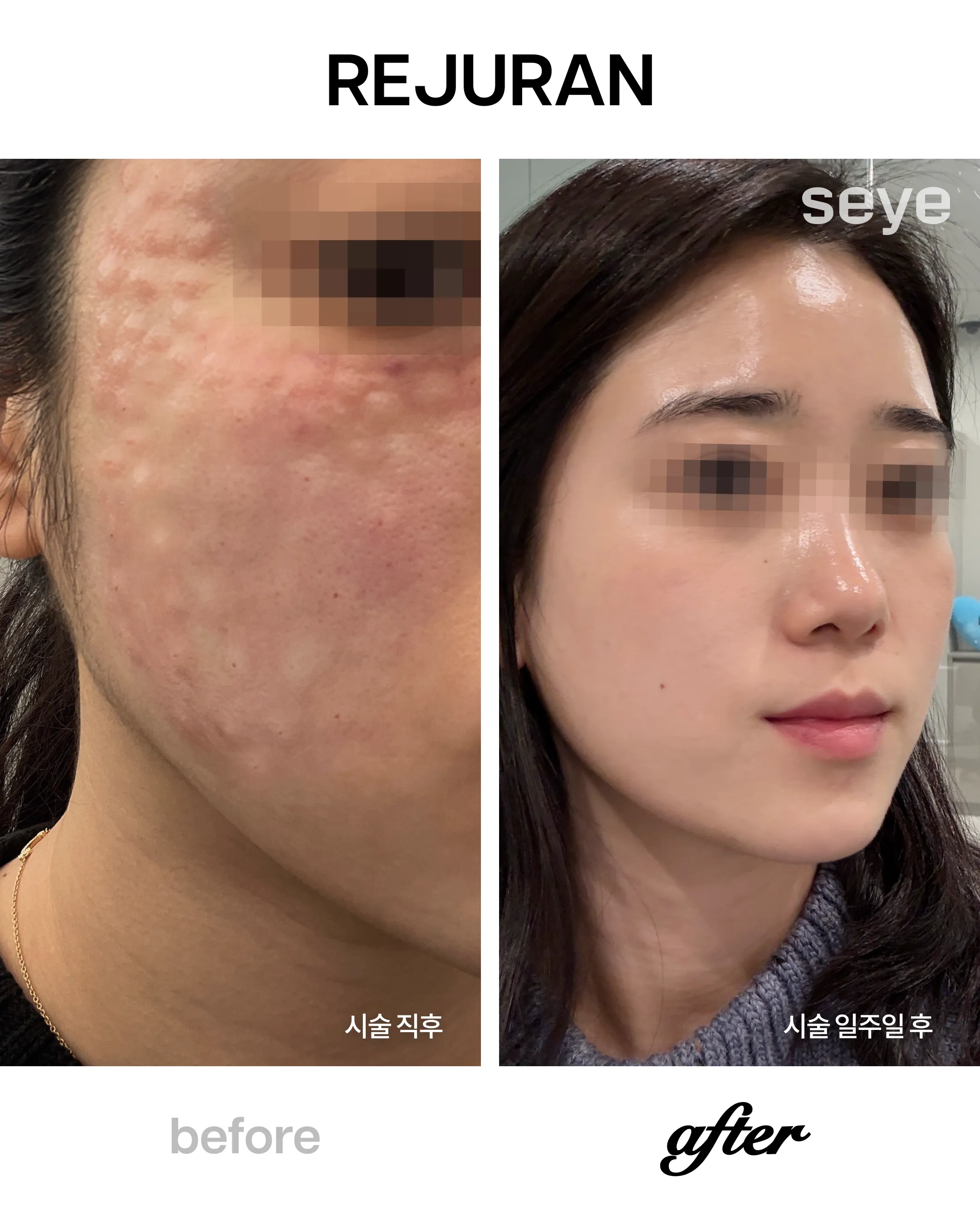 Rejuran before and after