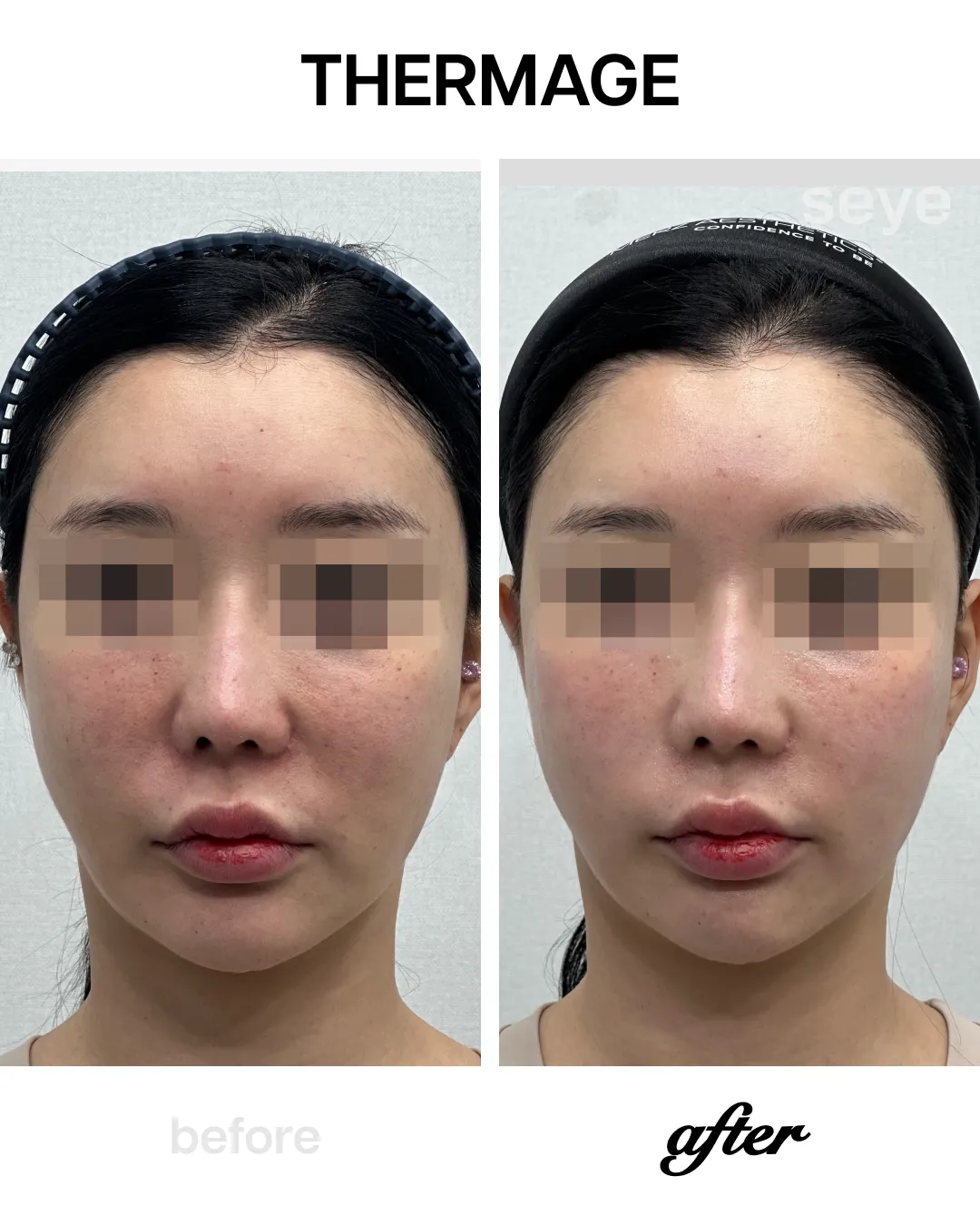 Thermage before and after