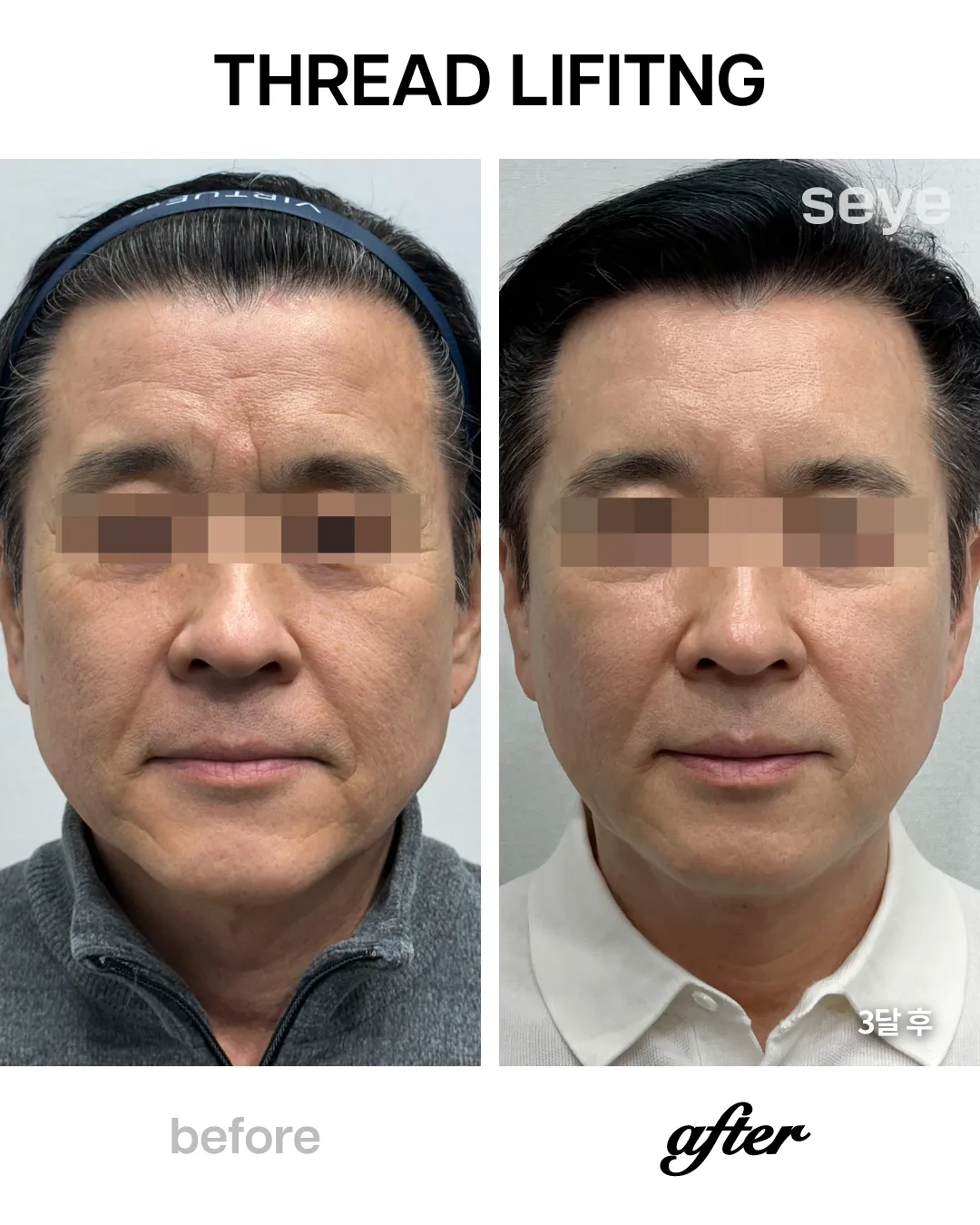 Thread lift before and after