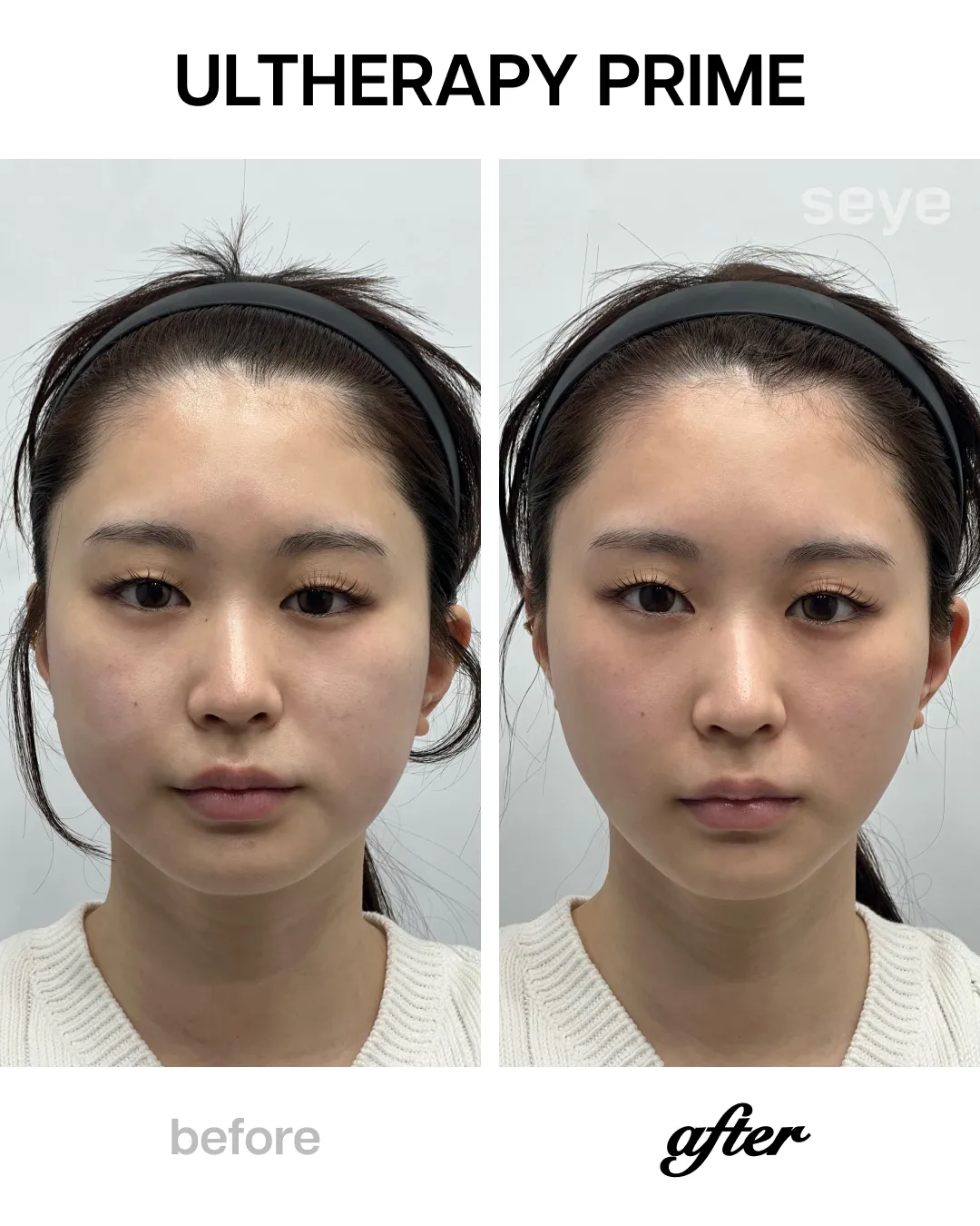 Ultherapy before and after