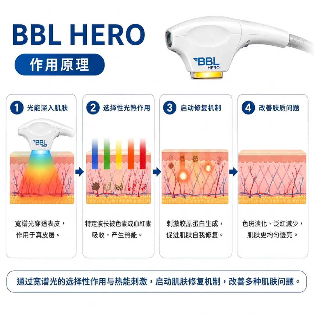 bbl-hero-ipl-brightening-bbl雷射-特定波长被色素或血红素吸收，产生热能。-BBL-HERO-刺激胶原蛋白生成，促进肌肤自我修复。-zh-cn.webp