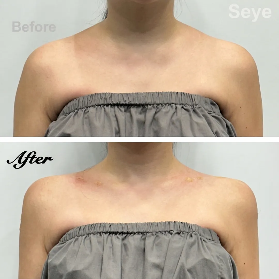 before-after-seye-en-1.webp