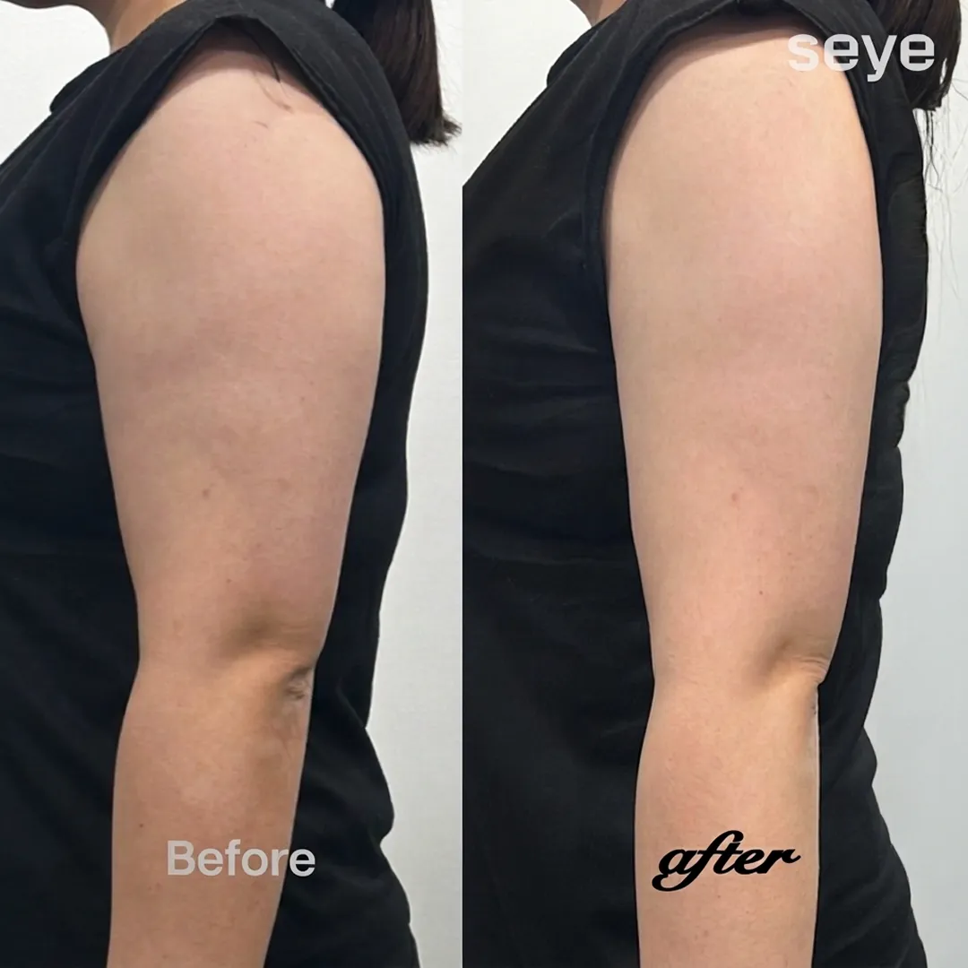 before-after-seye-en-2.webp