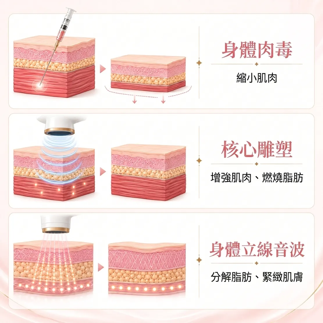body-botox-coresculpt-linearz-mechanism-增強肌肉、燃燒脂肪-身體立線音波-身體肉毒-縮小肌肉-zh-tw.webp