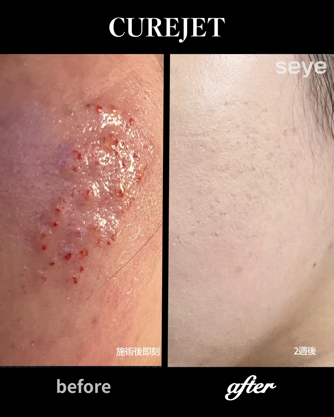 curejet效果-两周后效果-療程效果-去痘痘痘疤粉刺效果.webp