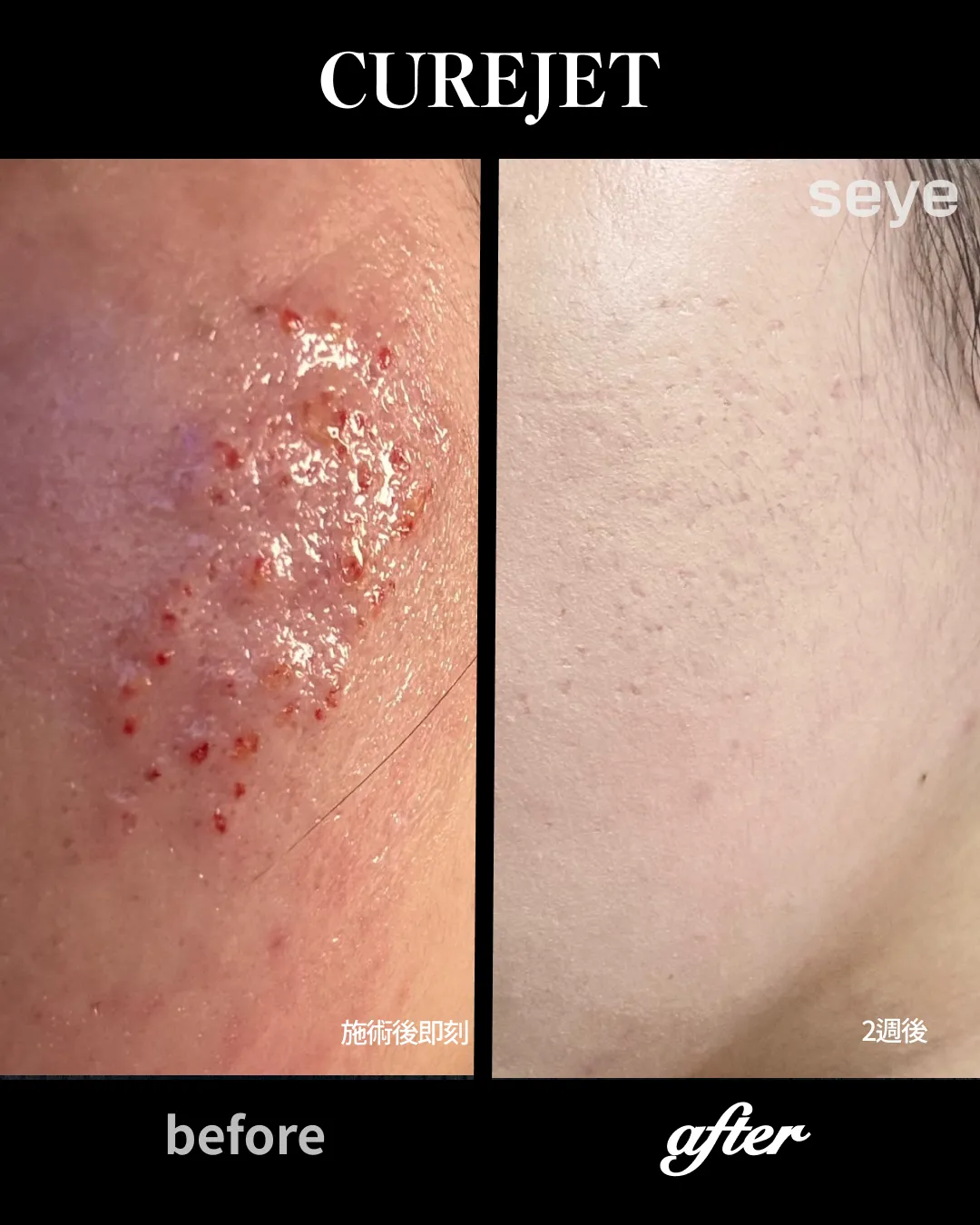 curejet效果-兩週後效果-療程效果-去痘痘痘疤粉刺效果.webp