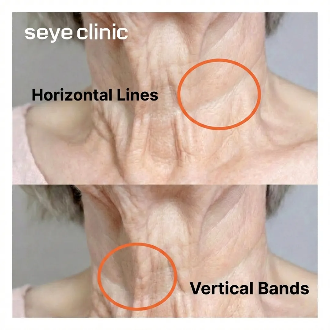 Before and after image showcasing the reduction of horizontal and vertical neck wrinkles with Seye Clinic's Tech Neck Injections.