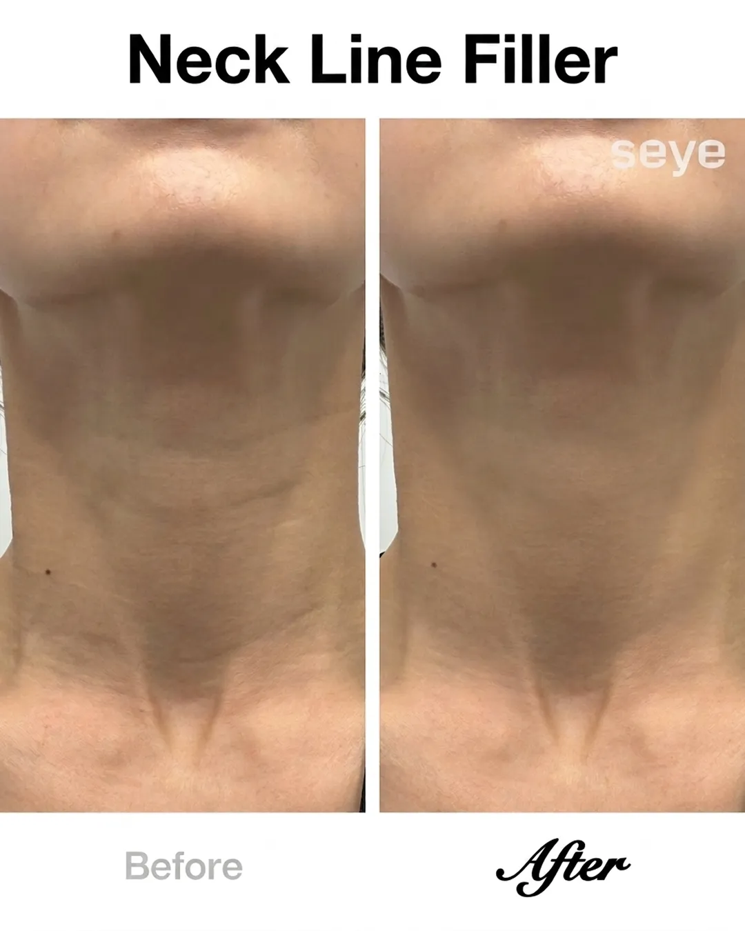 neck-line-filler-before-after-seye-en.webp