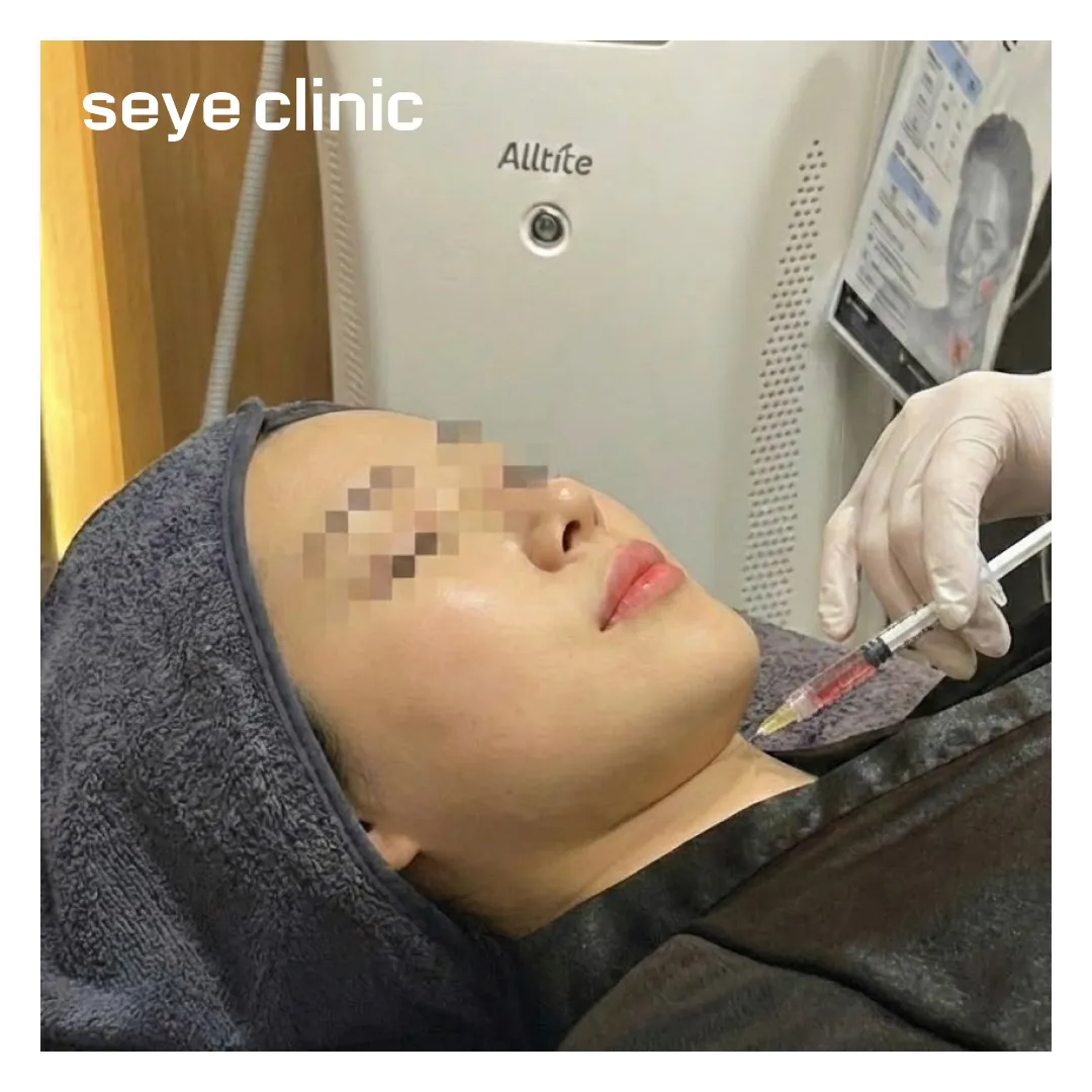 Before and after image showcasing the reduction of horizontal and vertical neck wrinkles with Seye Clinic's Tech Neck Injections.