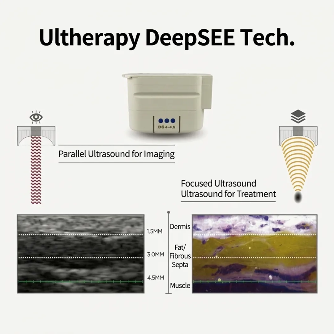 Comparison chart of Ultherapy for deep lifting vs. Thermage for skin tightening.