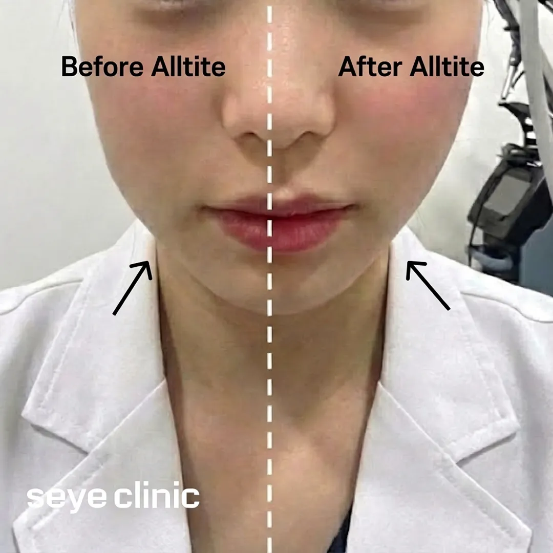 Before and after Alltite lifting for Korean jawline contouring
