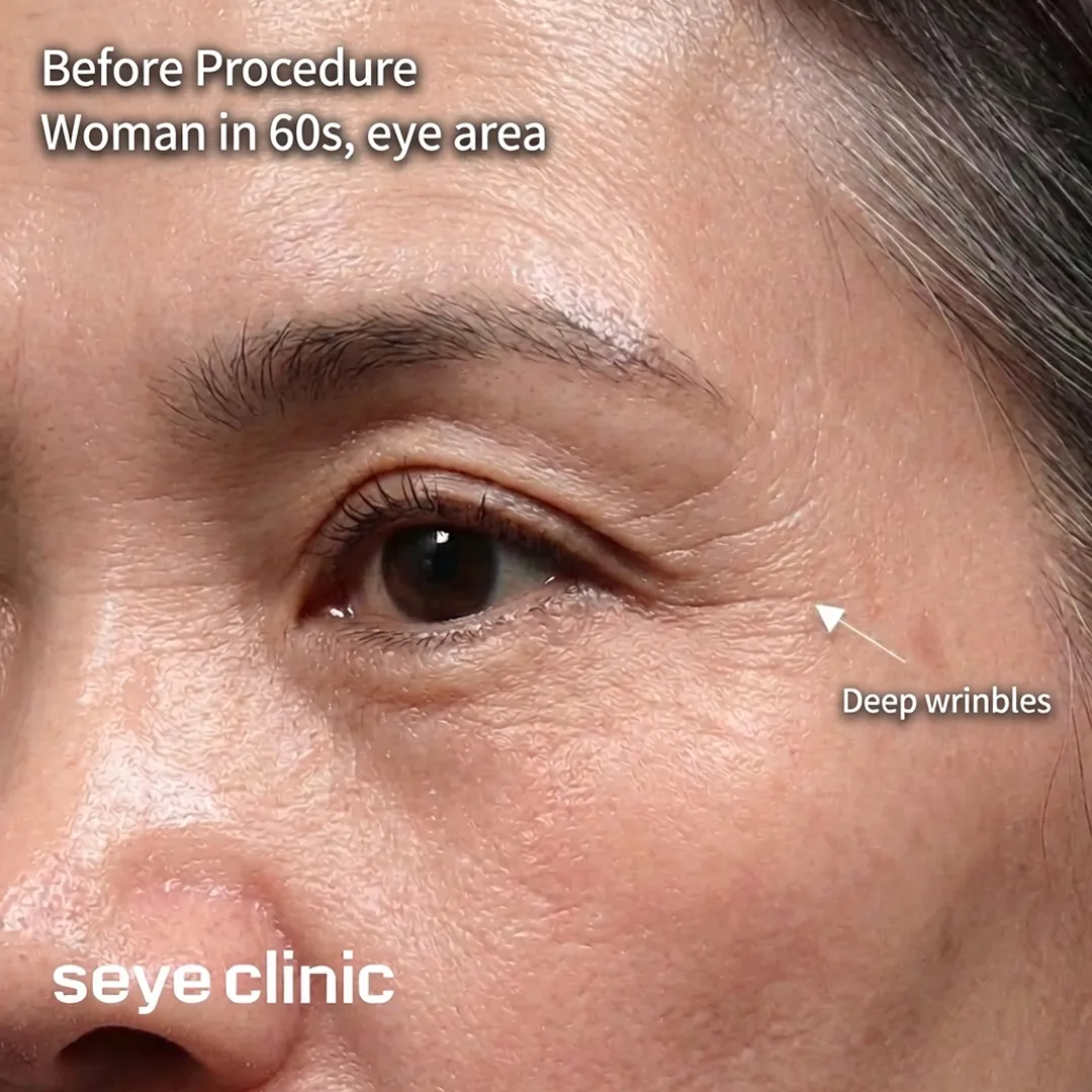 Before Eye Thermage Deep Wrinkles