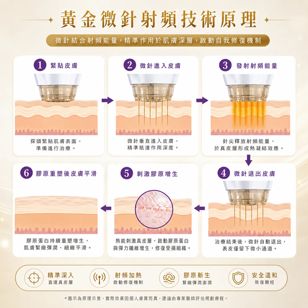 seyeclinic-gangnam-skin-consultation-黄金微针-射频-原理