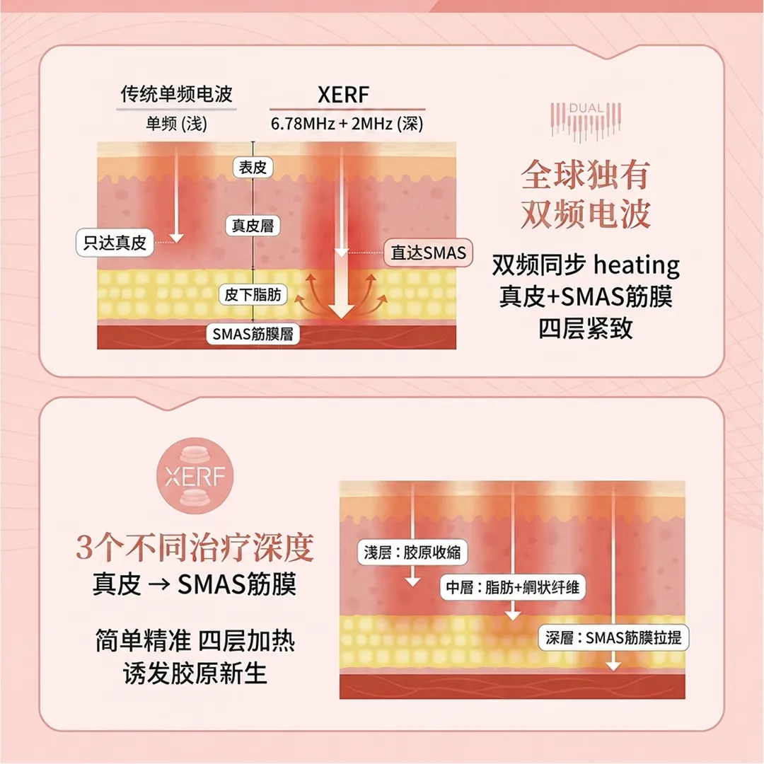 xerf电波-双频电波-紧致肌肤-治疗深度-smas筋膜层-双频同步-heating-单频-浅-传统单频电波-胶原新生-表皮-zh-cn.webp