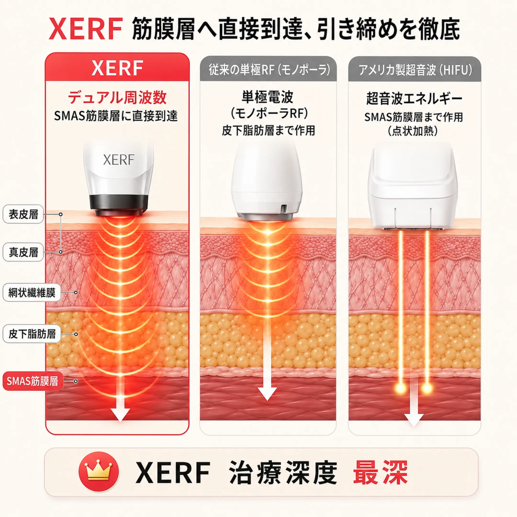 xerf-vs-monopolar-rf-hifu-shinto-depth-hikaku.webp